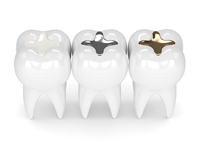 types of dental fillings