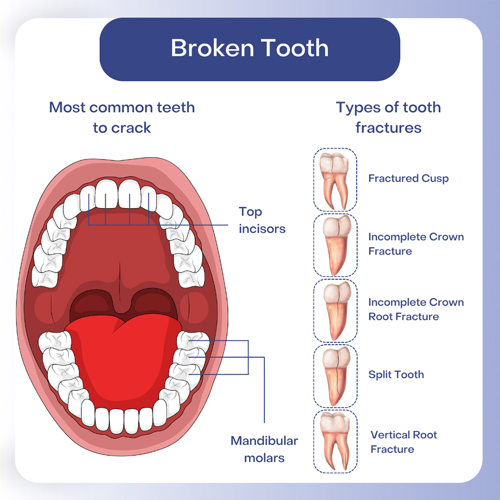 Broken Tooth