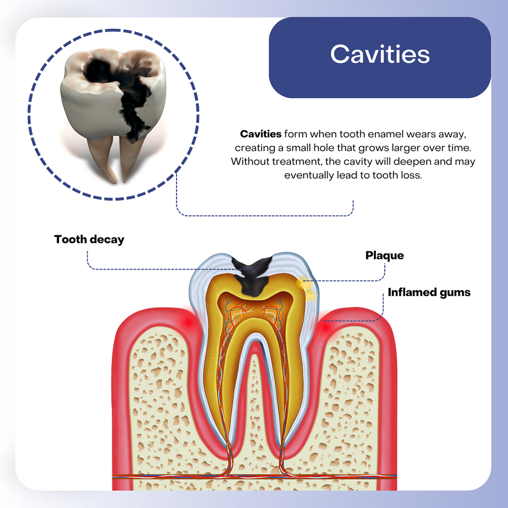 Cavities