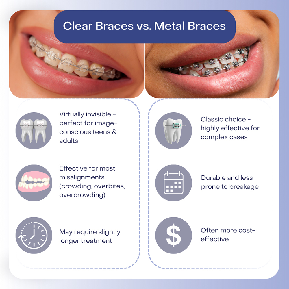 Clear Braces vs Metal Braces