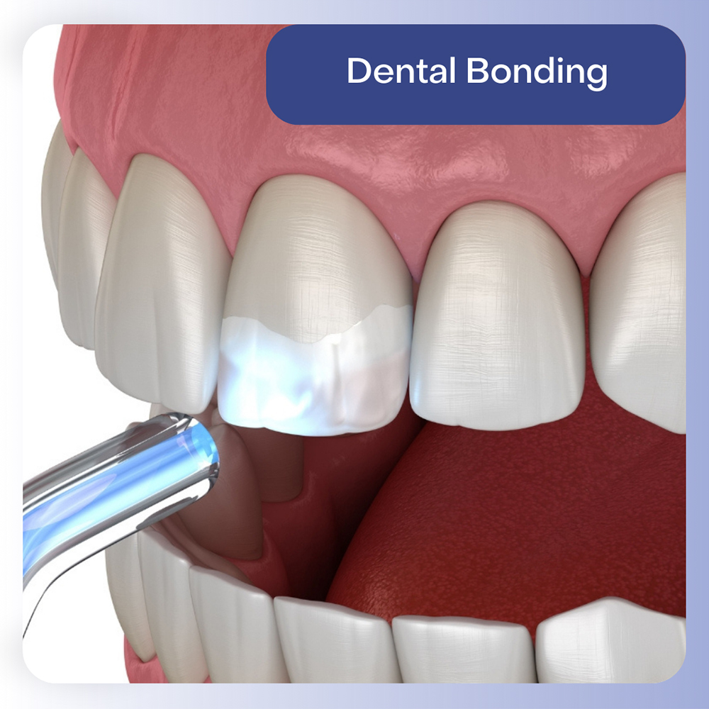 Dental Bonding