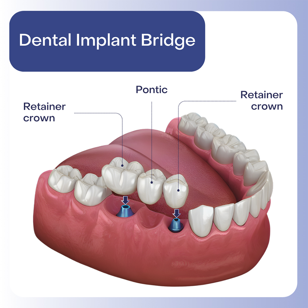 Dental Implant Bridge