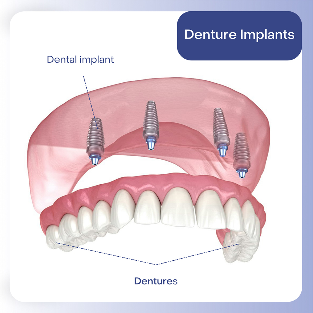 Denture Implants