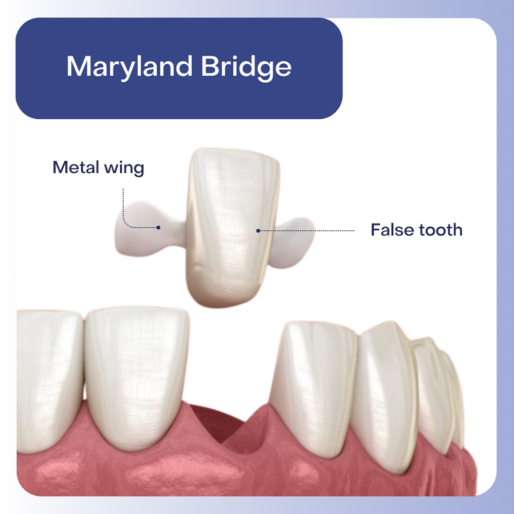 Maryland Bridge