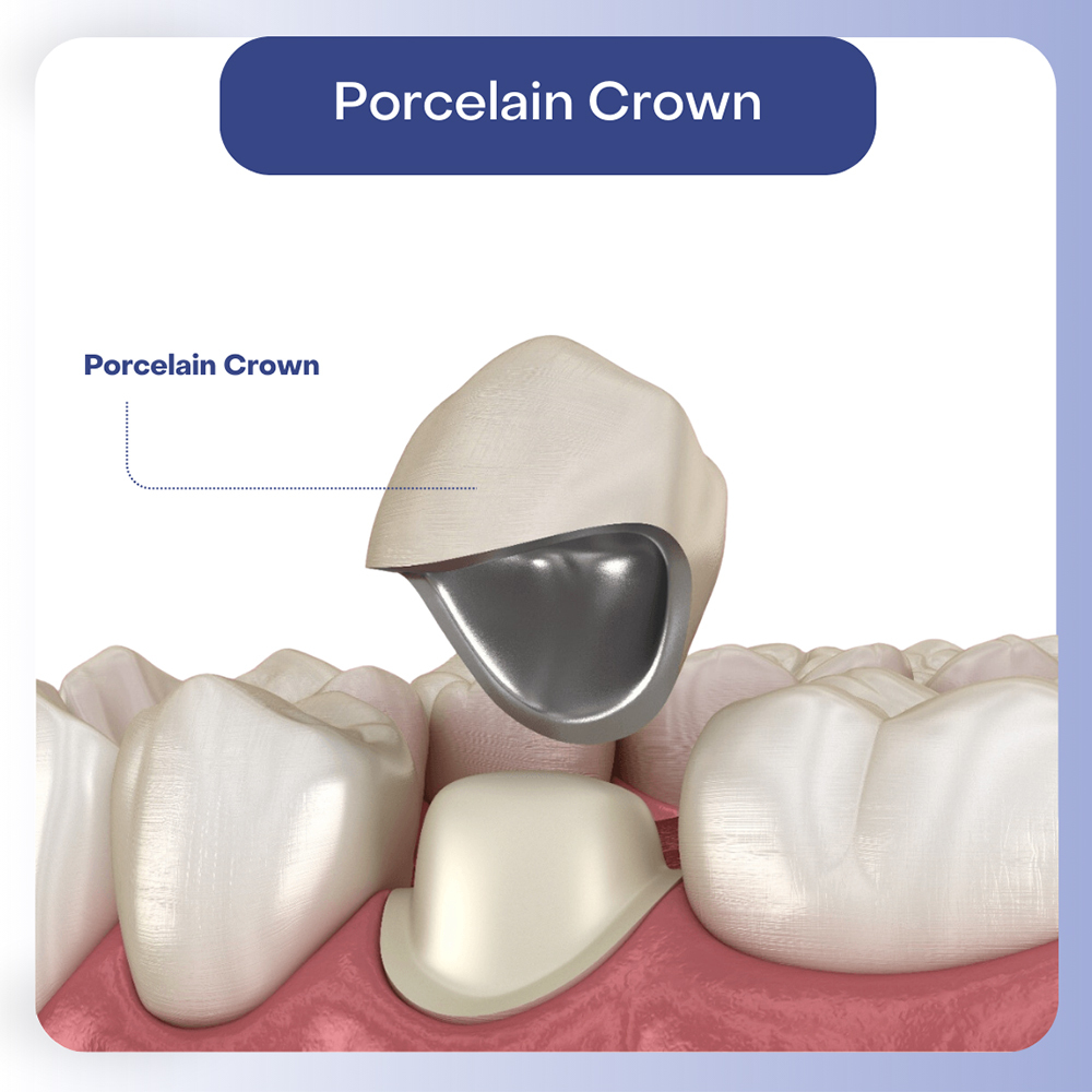 Porcelain Crowns
