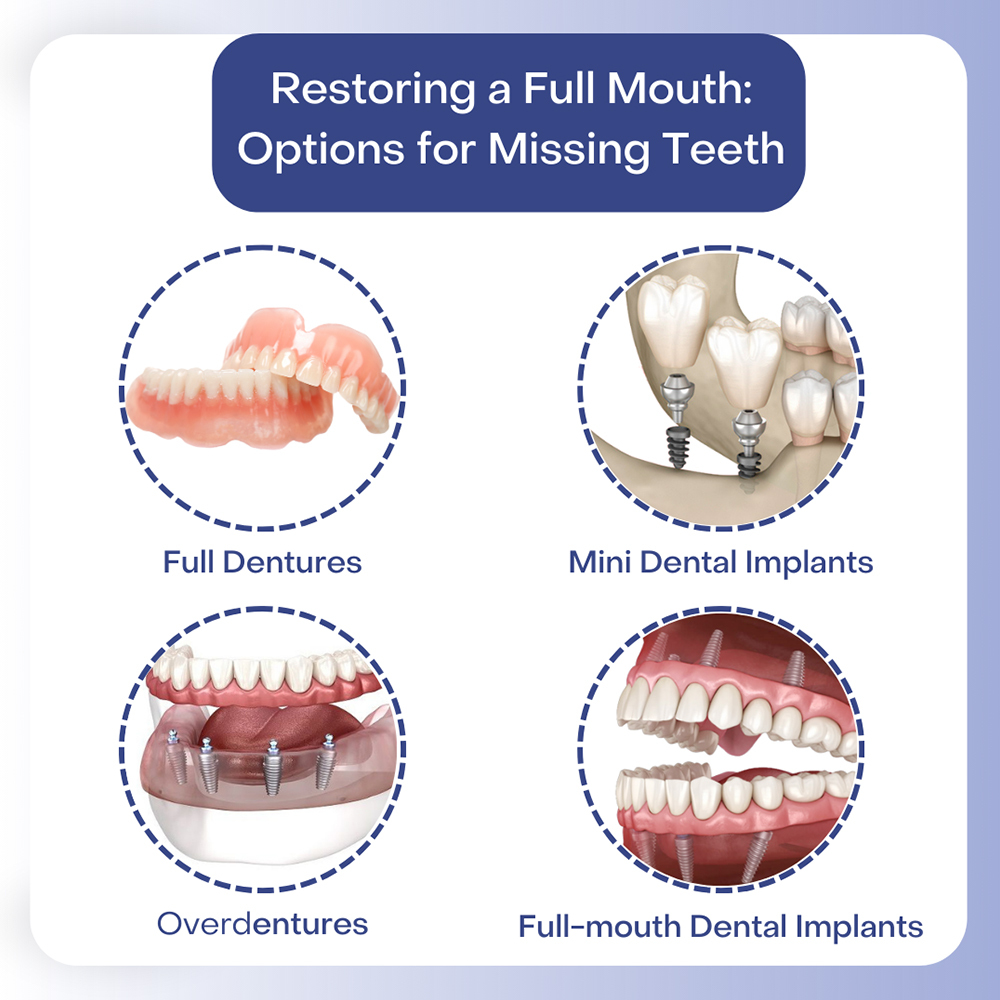 Restoring a Full Mouth Option for Missing Teeth