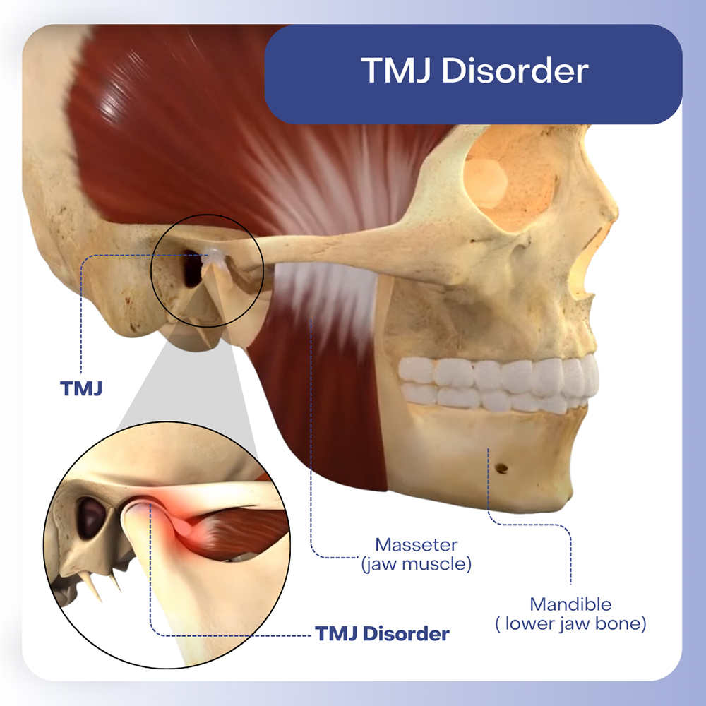 TMJ Disorders