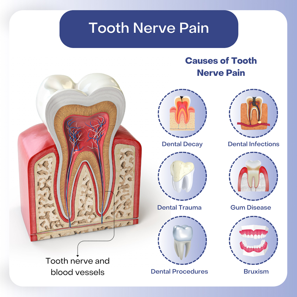 Tooth Nerve Pain