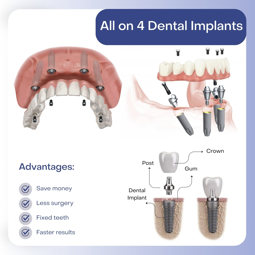 All on 4 Dental Implants