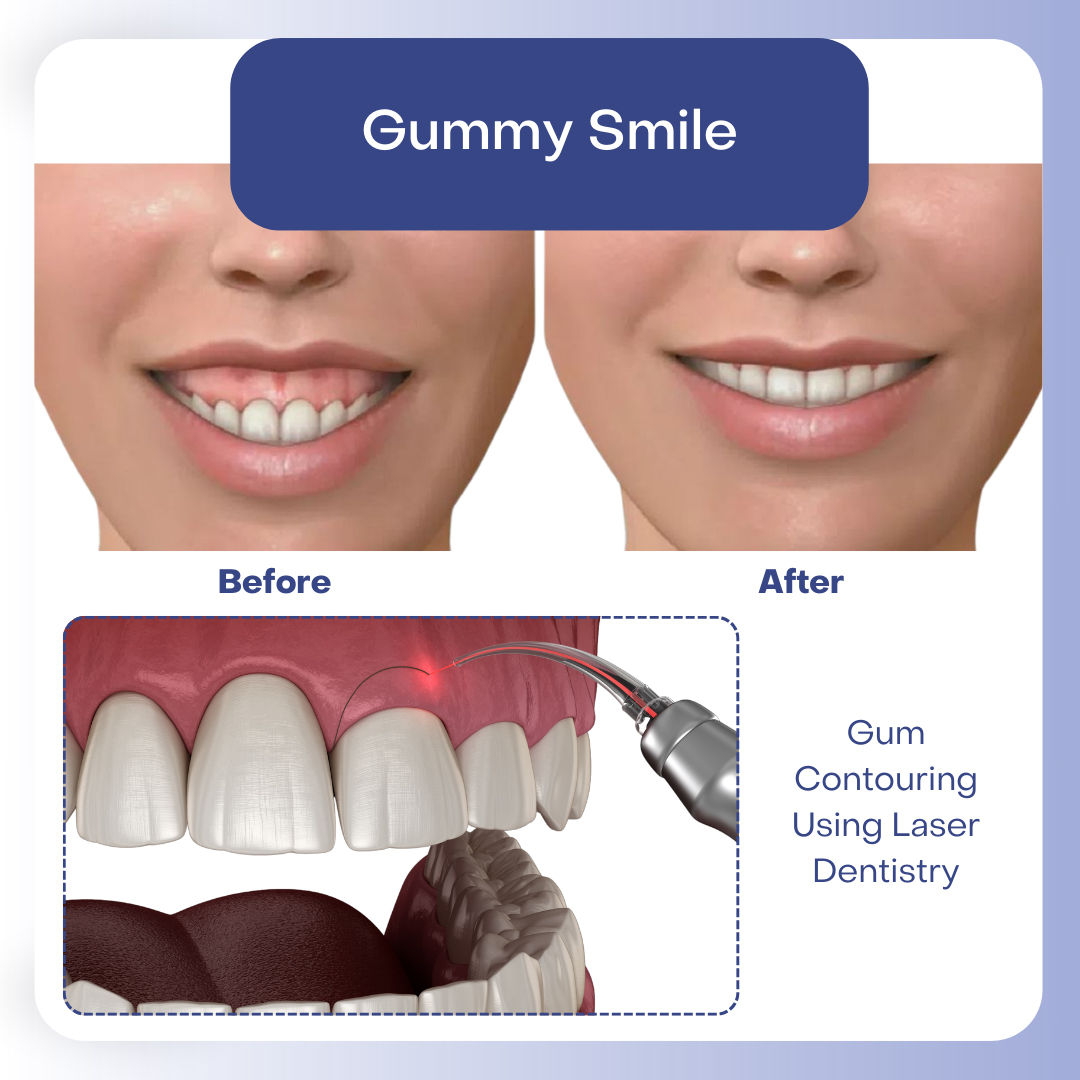 Gum Recontouring Using Laser Dentistry