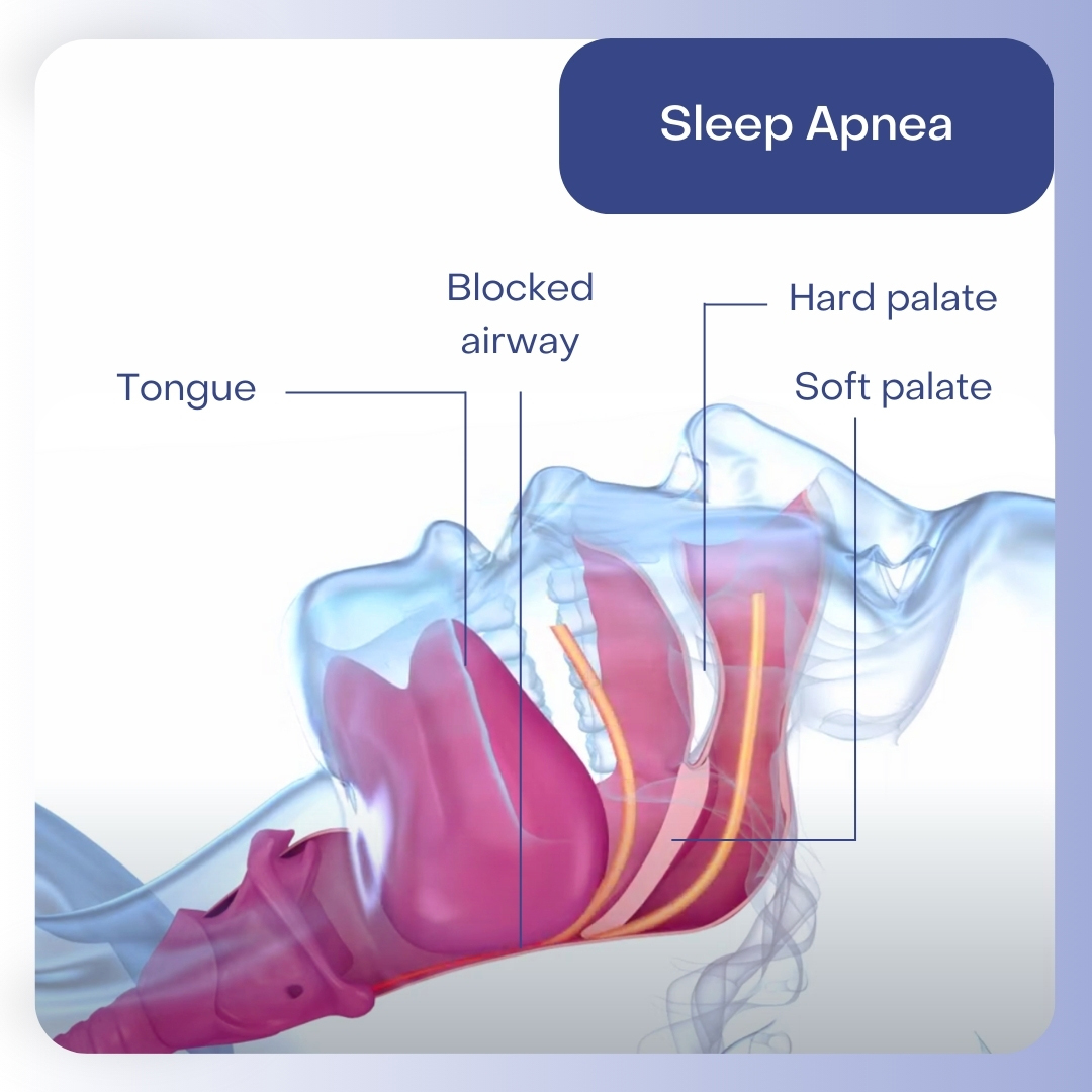 Sleep Apnea
