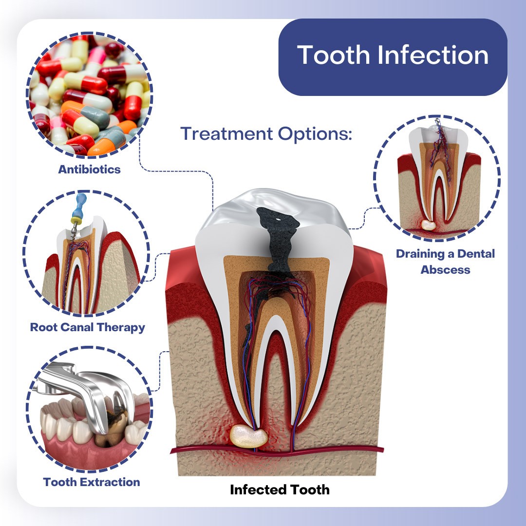 Tooth Infection